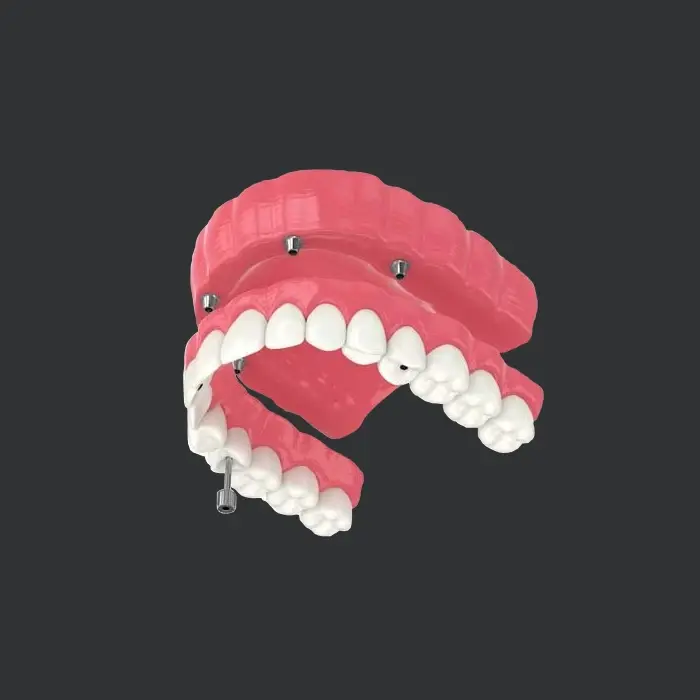 model of all on 4 dental implants